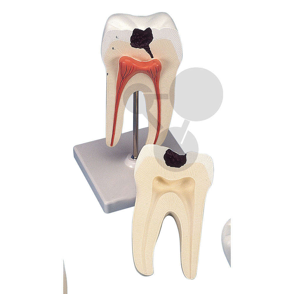 Dolny dwukorzeniowy ząb trzonowy z próchnicą, 2-częściowy, Premium
