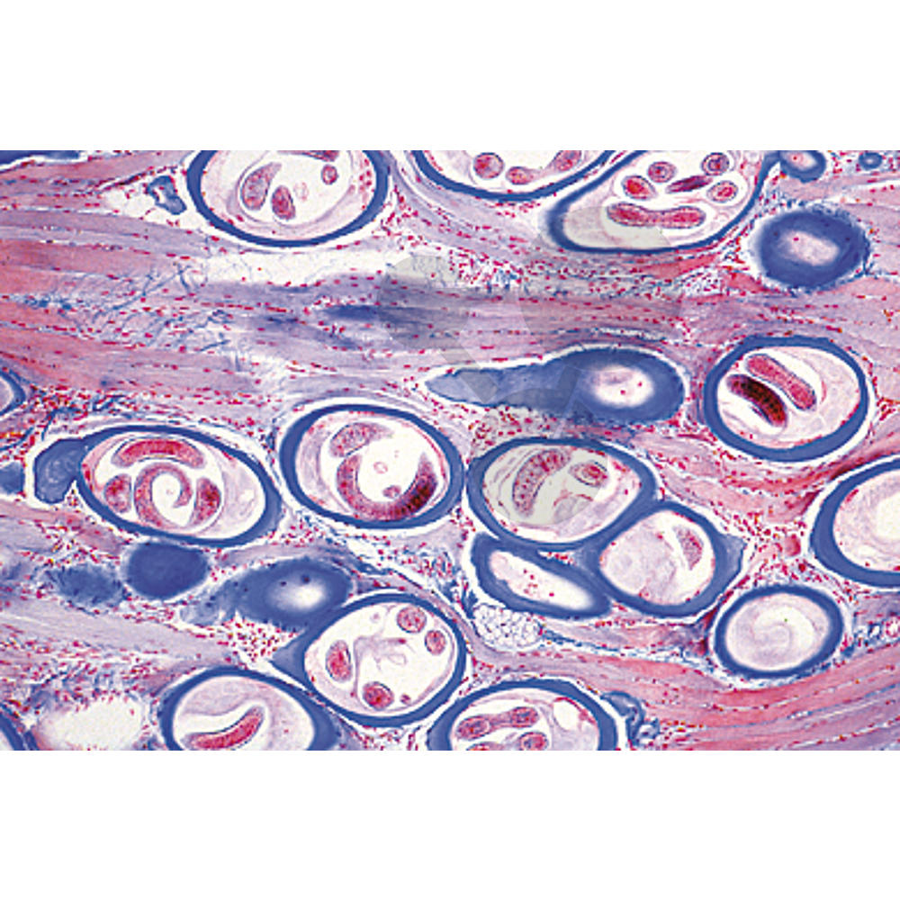 Trichinella igg. Трихинелла гистология. Трихинеллез патологическая анатомия.